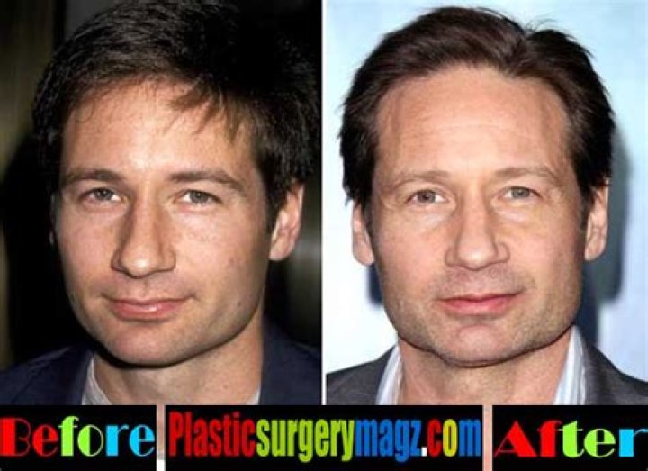 David Duchovny Plastic Surgery Before and After