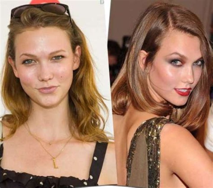 Karlie Kloss Plastic Surgery Before and After